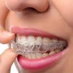 Detailed information about teeth straightening aligners
